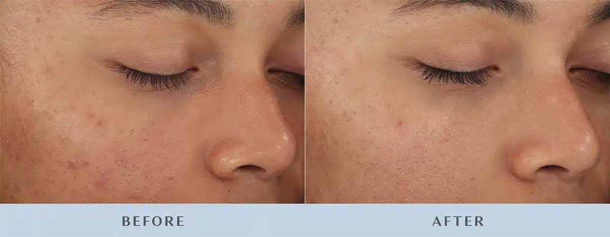 4 weeks diamondglow.jpg