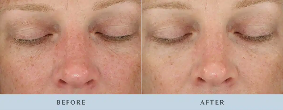 6 weeks diamondglow.jpg