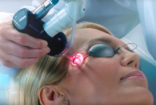 Acupulse face 500x338