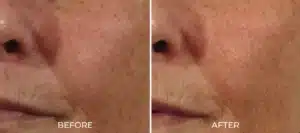 Glo2Facial BA cheek1 2048x910.jpg