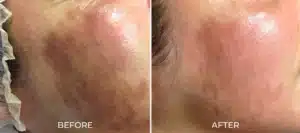 Glo2Facial BA cheek2 2048x910.jpg