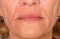 hyaluronic acid13244 scaled