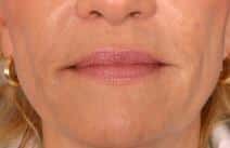 hyaluronic acid13245 scaled