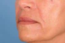 hyaluronic acid13246 scaled