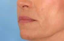 hyaluronic acid13247 scaled