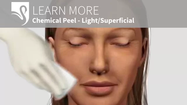 3D Video chemical peel superficial