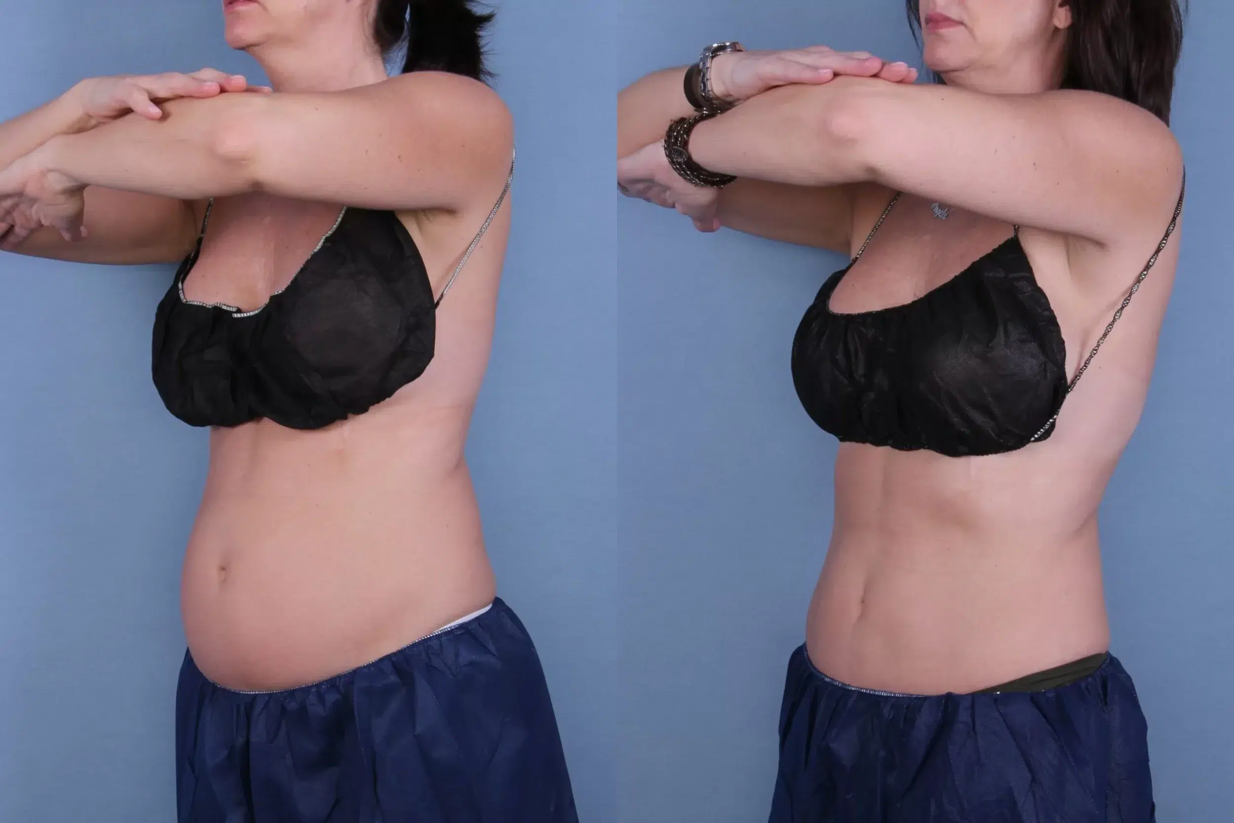 Before and After Image: CoolSculpting Case #22132 - left-front-oblique