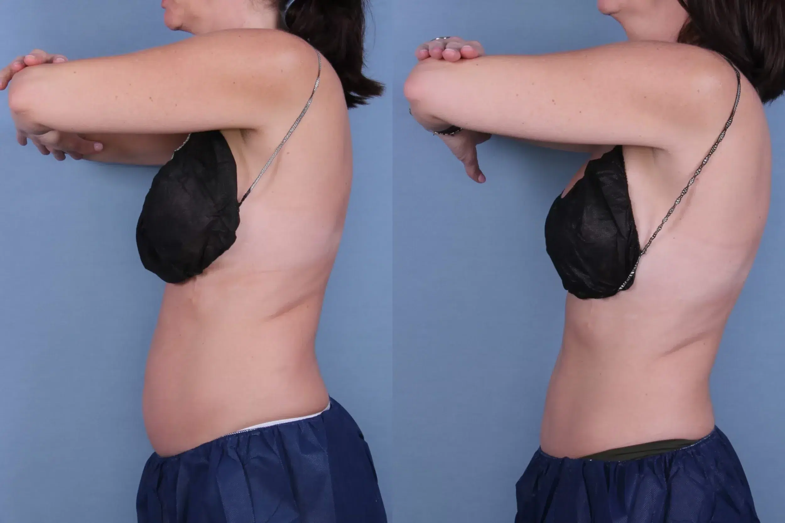 Before and After Image: CoolSculpting Case #22132 - left-side