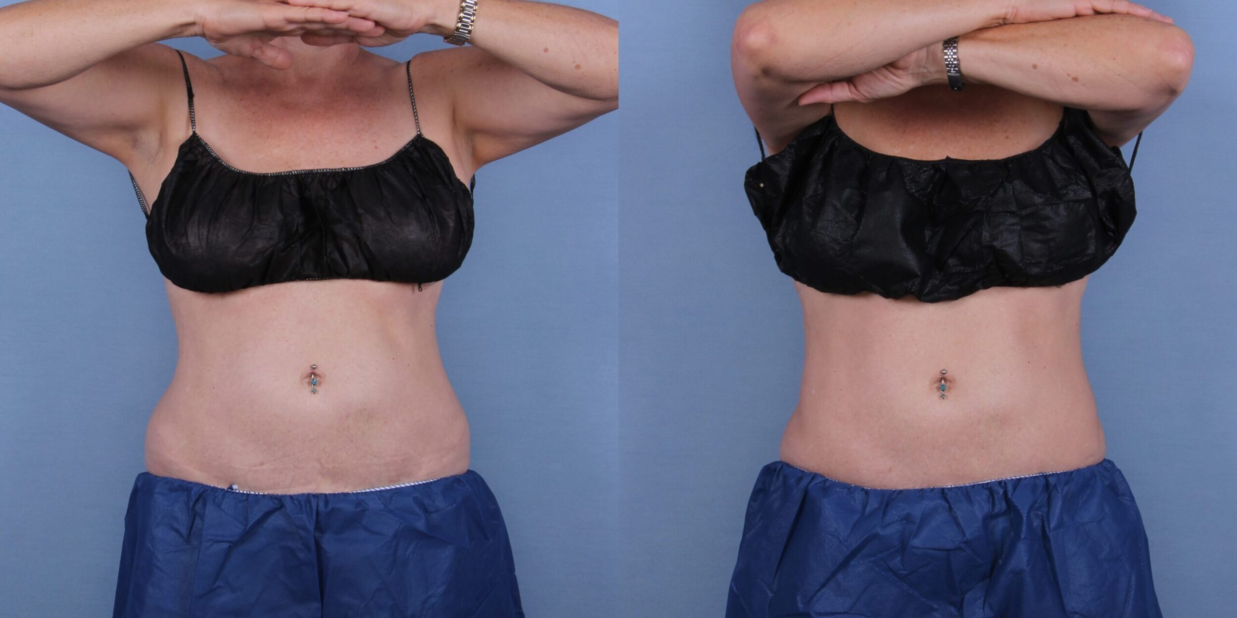 Before and After Image: CoolSculpting Case #29769 - front