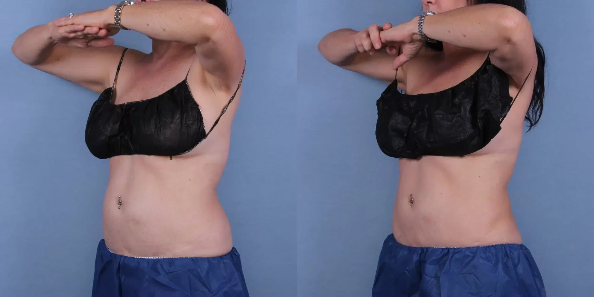 Before and After Image: CoolSculpting Case #29769 - left-front-oblique