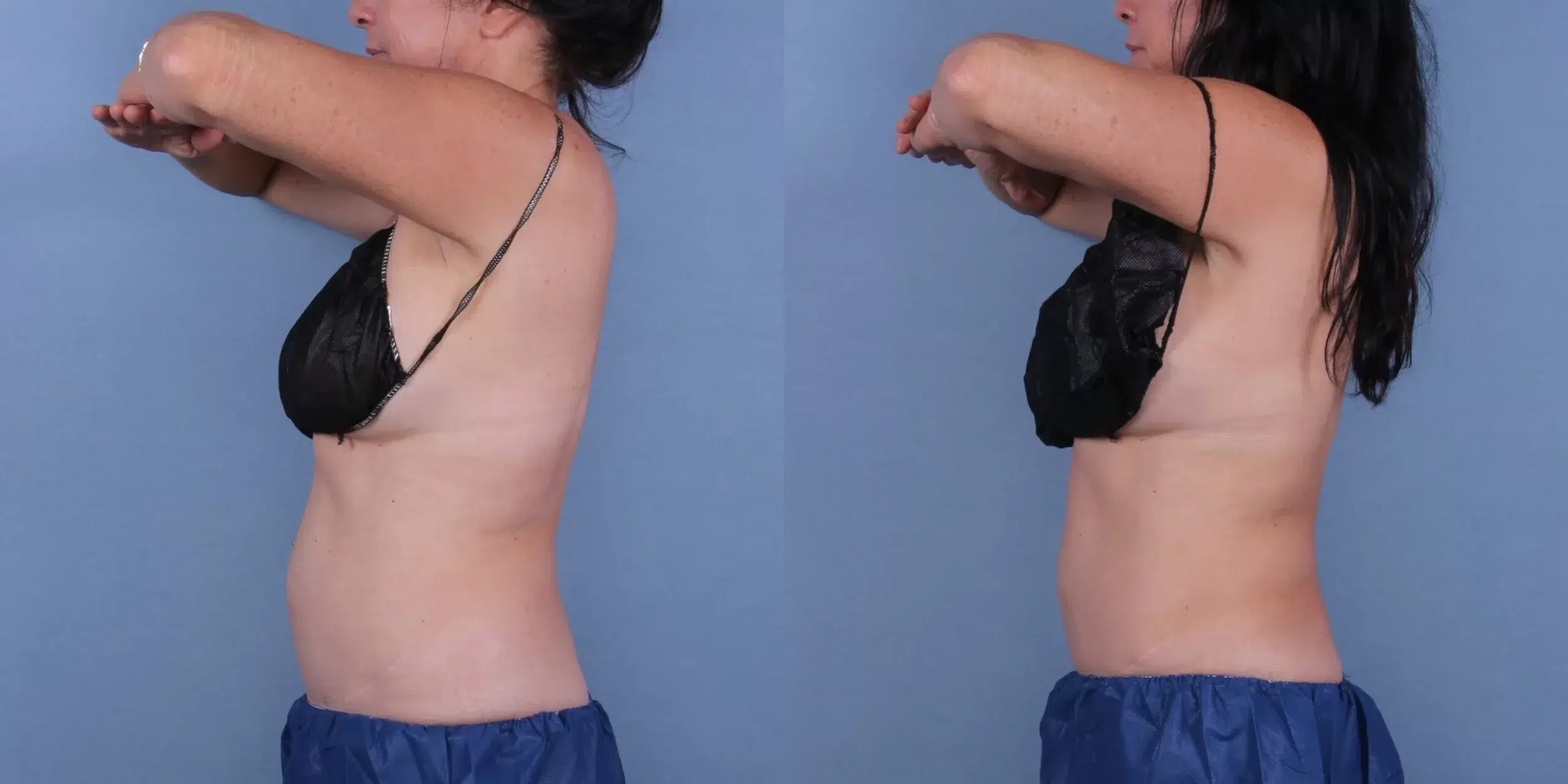 Before and After Image: CoolSculpting Case #29769 - left-side