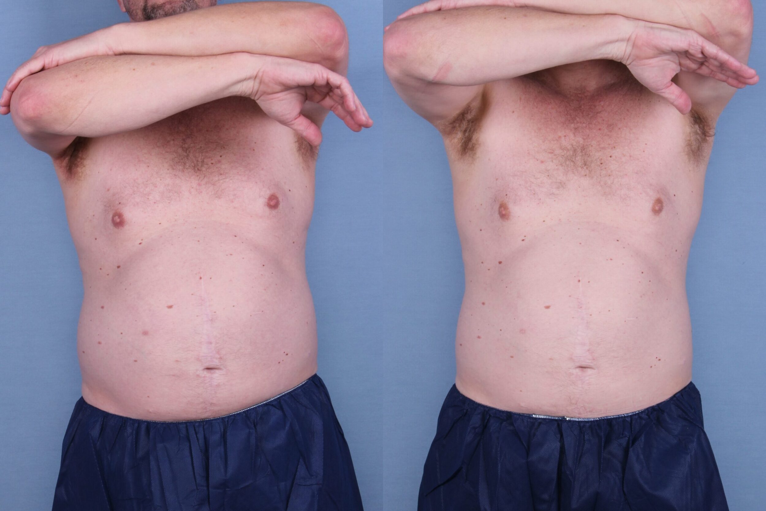 Before and After Image: CoolSculpting Case #38739 - front