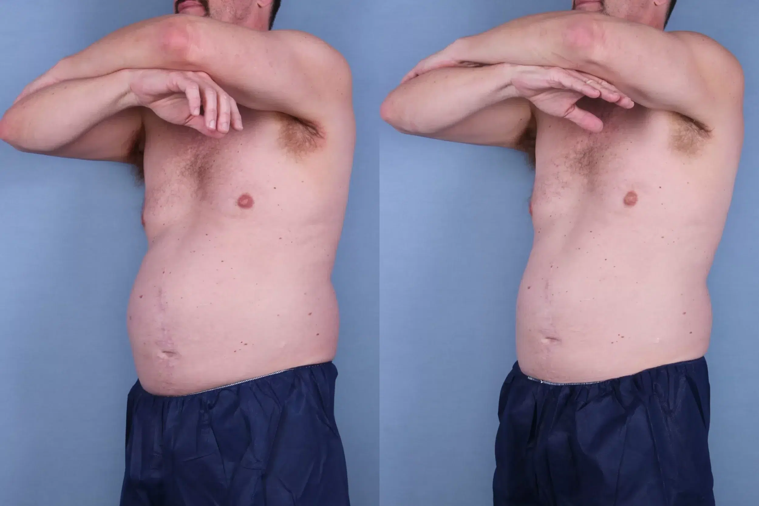Before and After Image: CoolSculpting Case #38739 - left-front-oblique