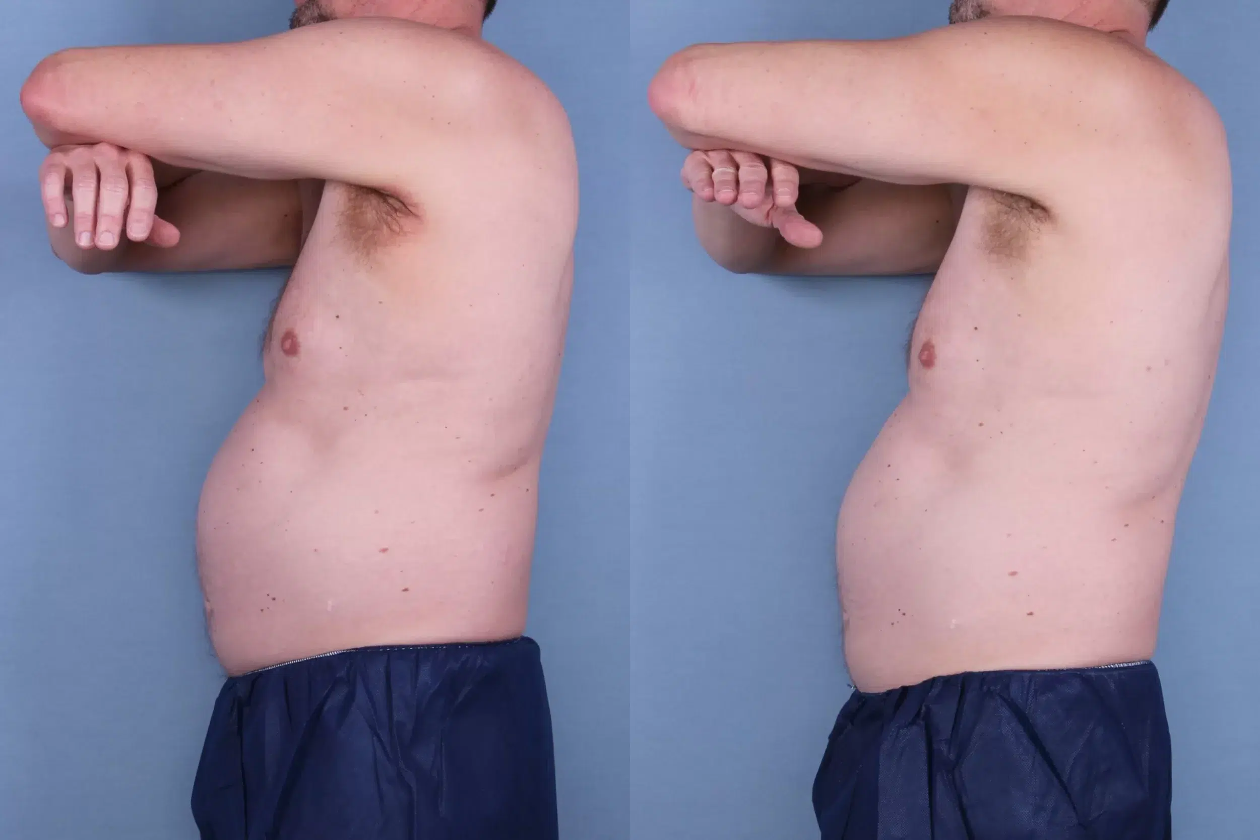 Before and After Image: CoolSculpting Case #38739 - left-side