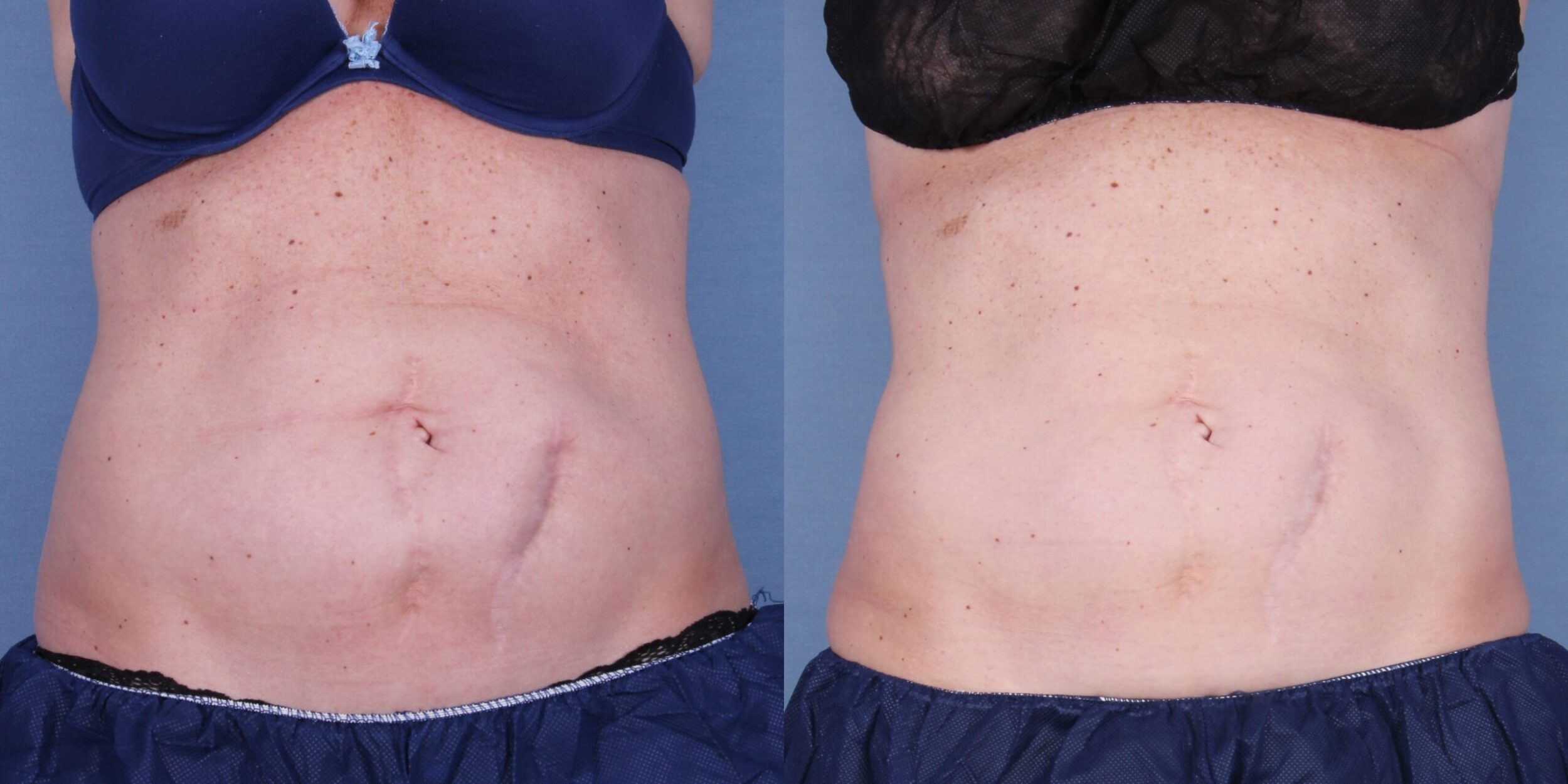 Before and After Image: CoolSculpting Case #45108 - front