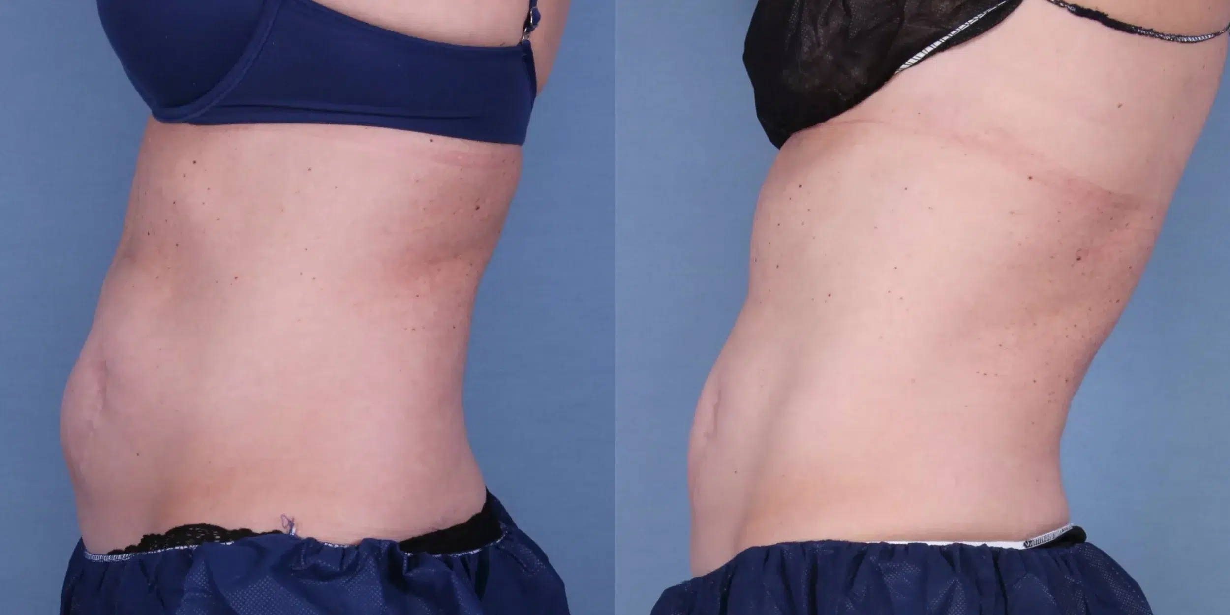 Before and After Image: CoolSculpting Case #45108 - left-side