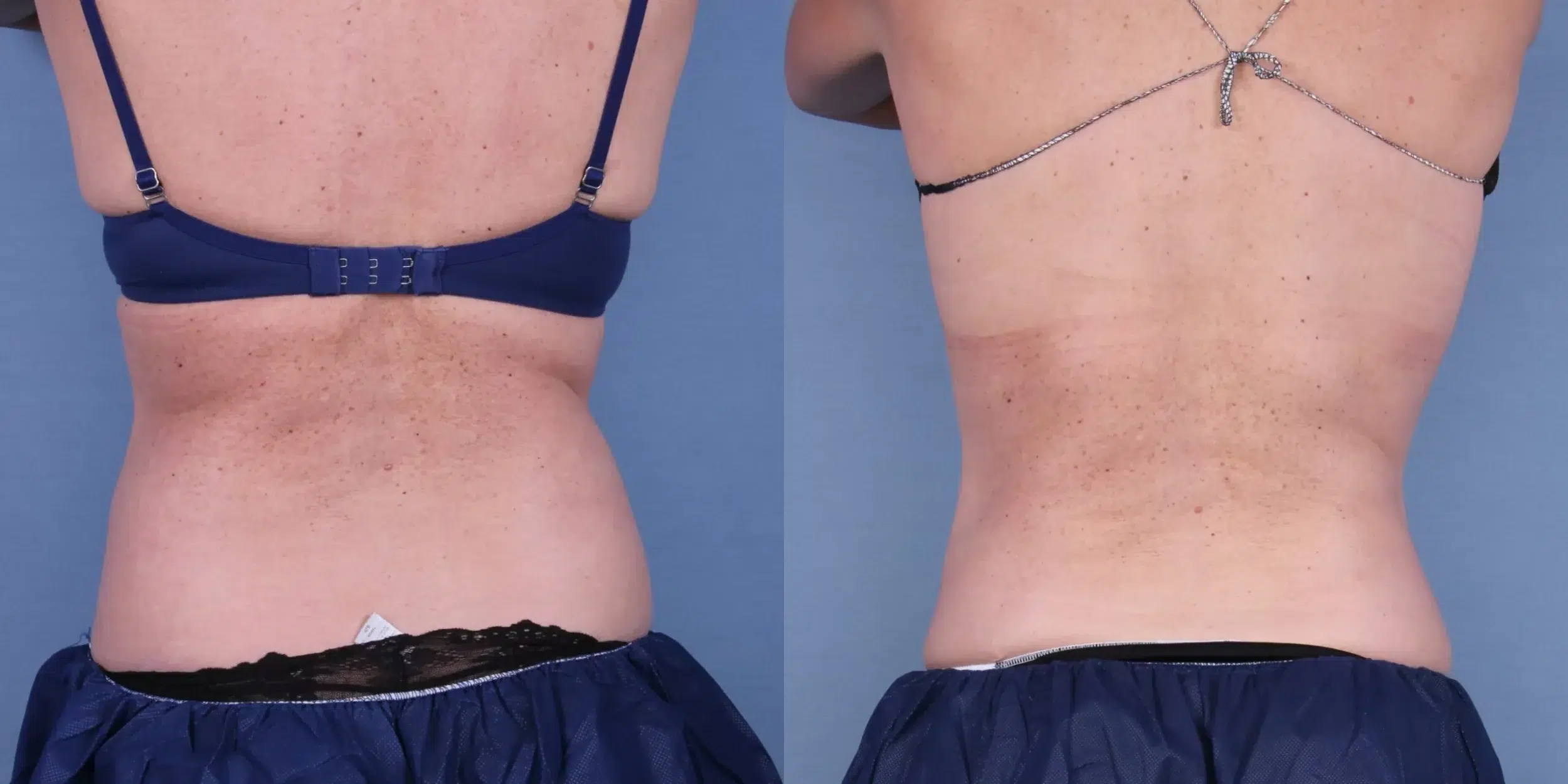 Before and After Image: CoolSculpting Case #45108 - back