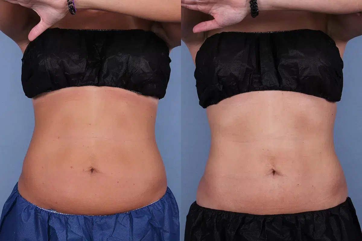 Before and After Image: CoolSculpting Case #54965 - front