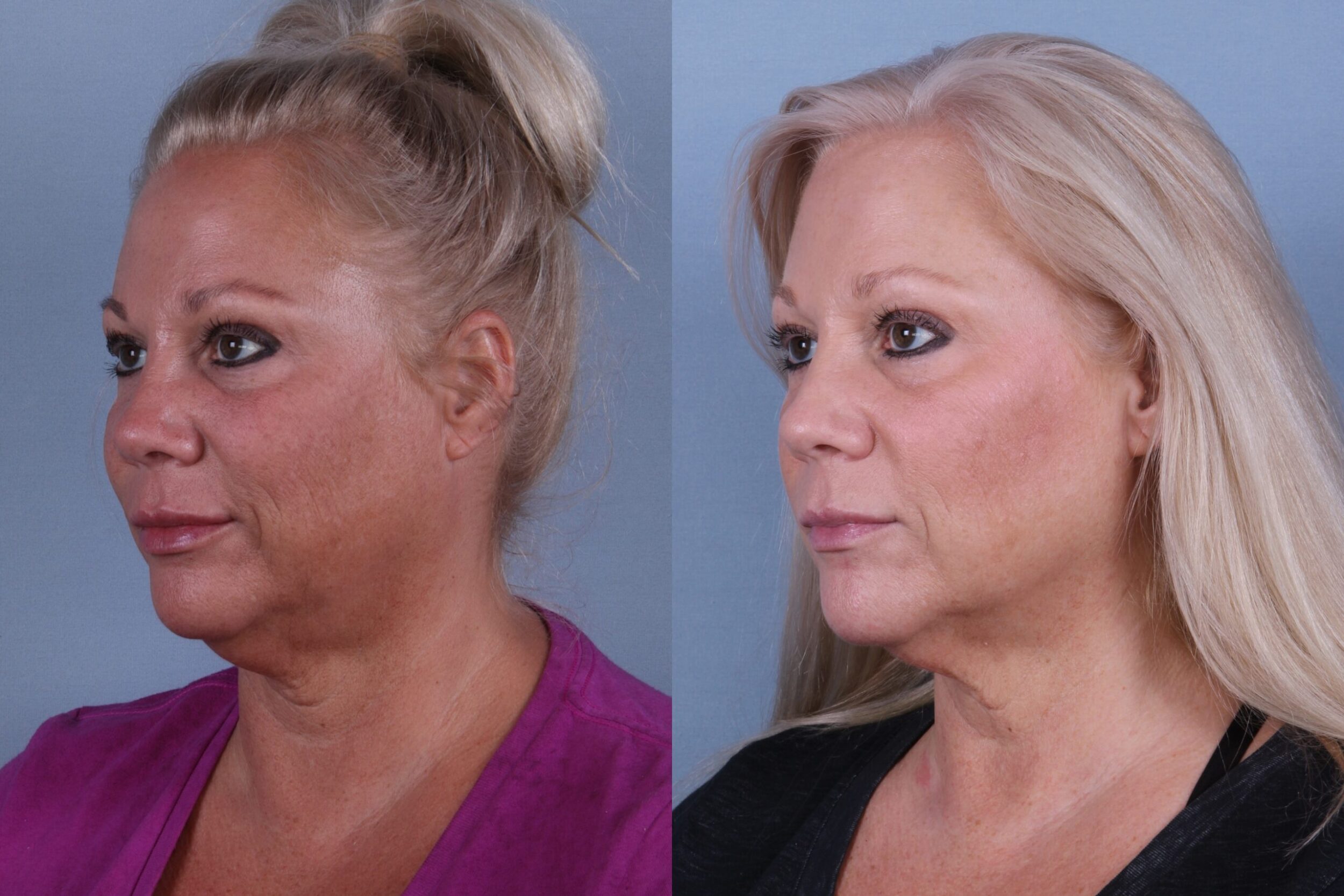 Before and After Image: CoolSculpting Case #55389 - left-front-oblique