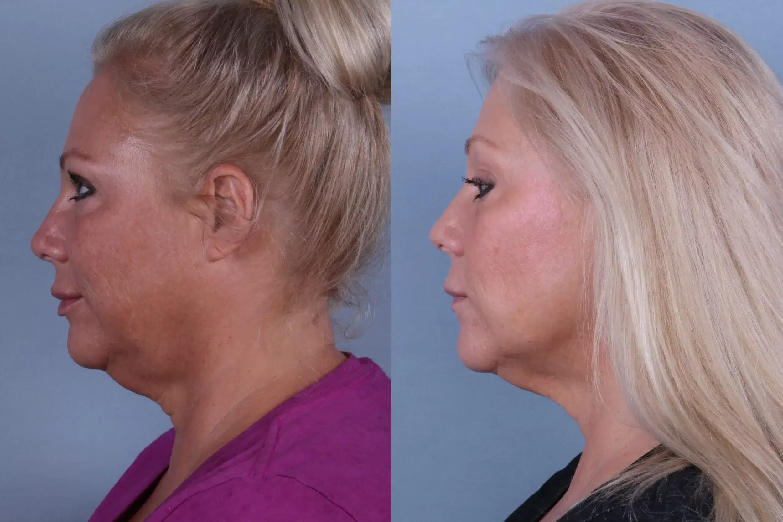 Before and After Image: CoolSculpting Case #55389 - left-side