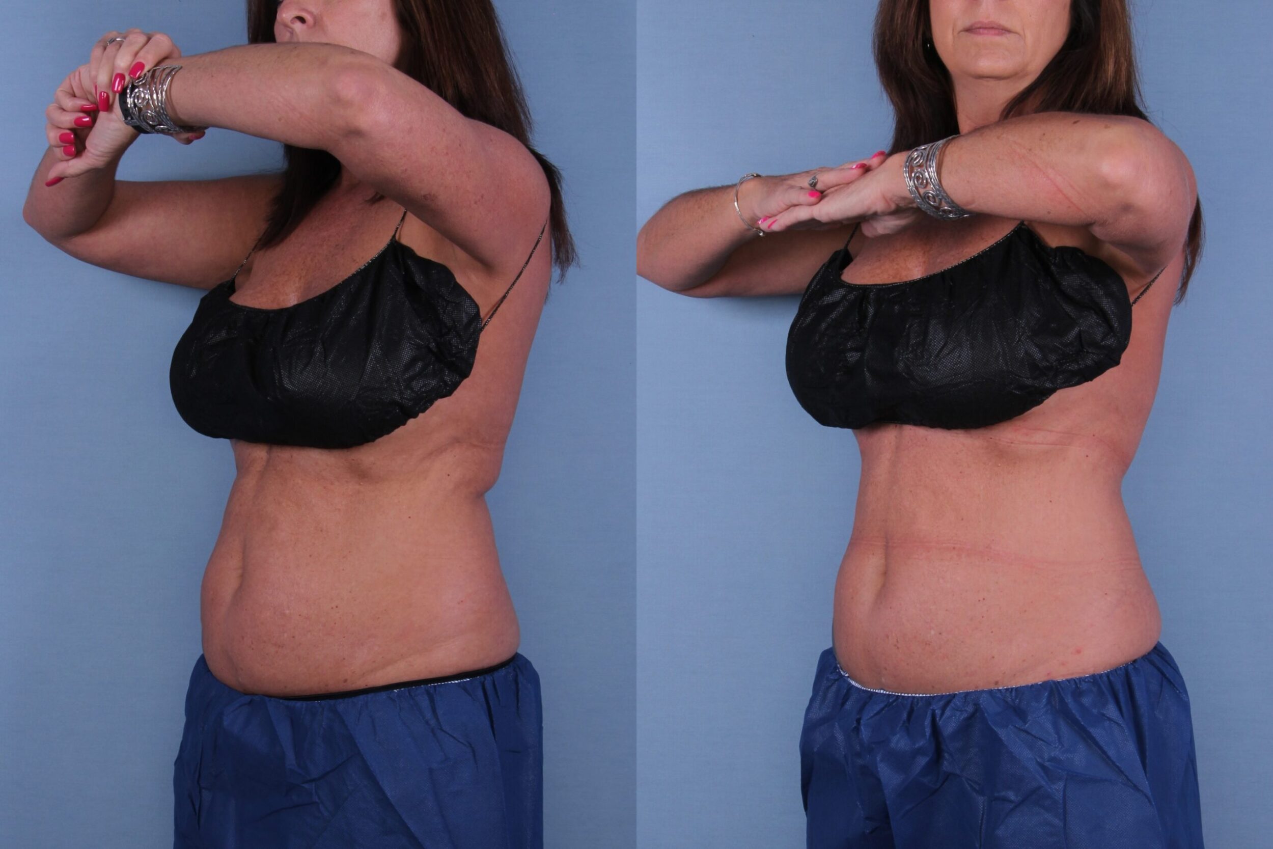 Before and After Image: CoolSculpting Case #56431 - left-front-oblique