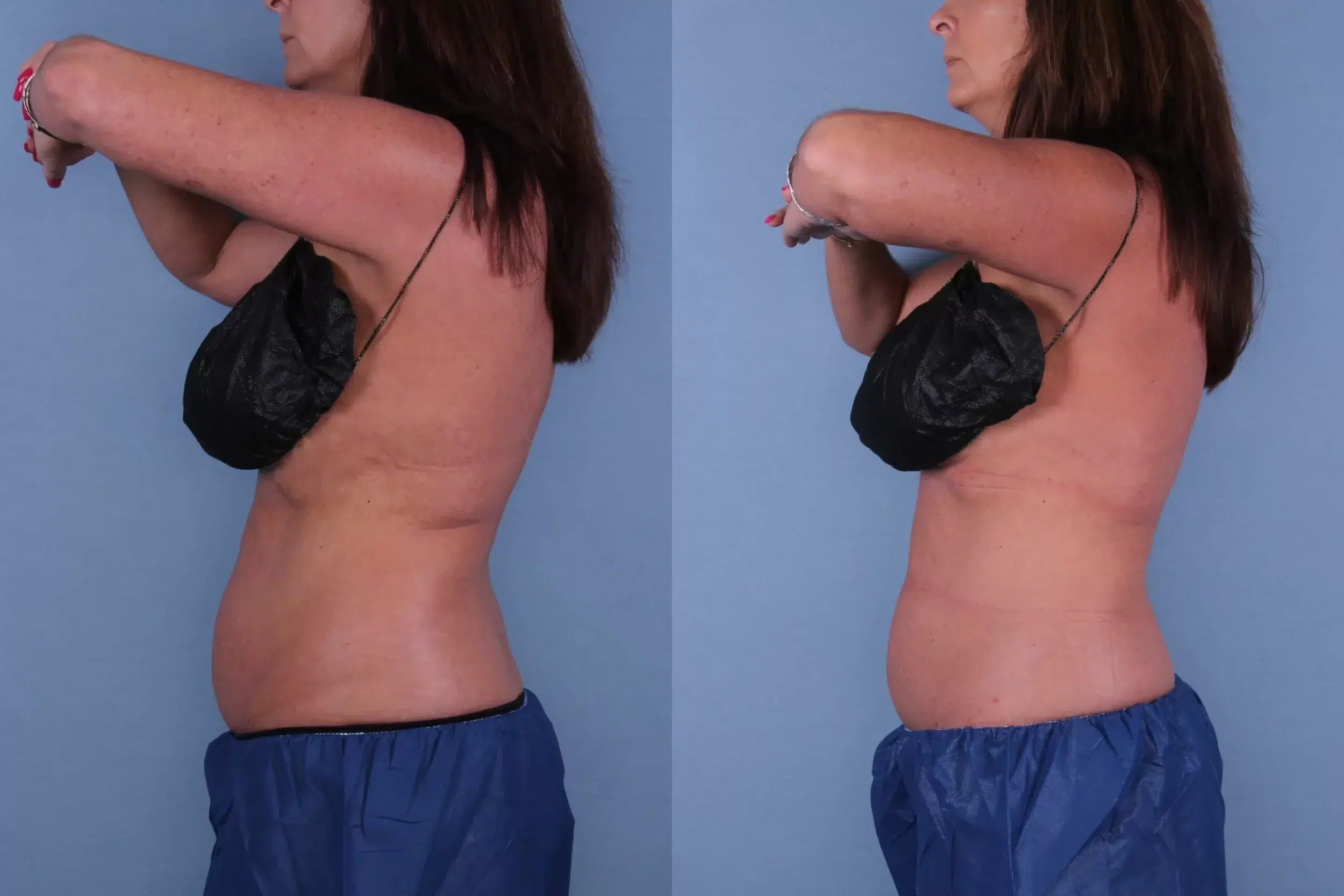 Before and After Image: CoolSculpting Case #56431 - left-side