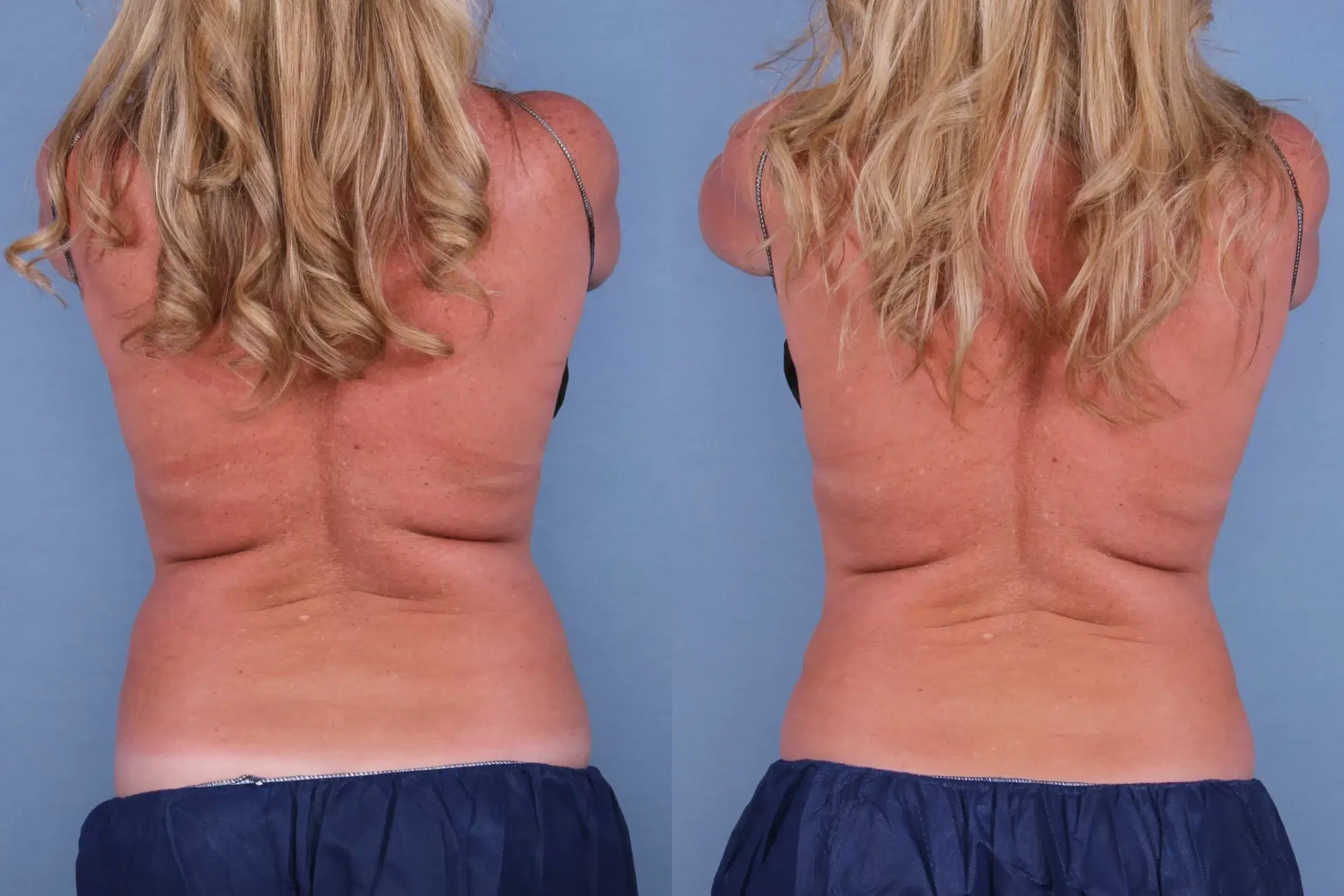Before and After Image: CoolSculpting Case #56433 - back