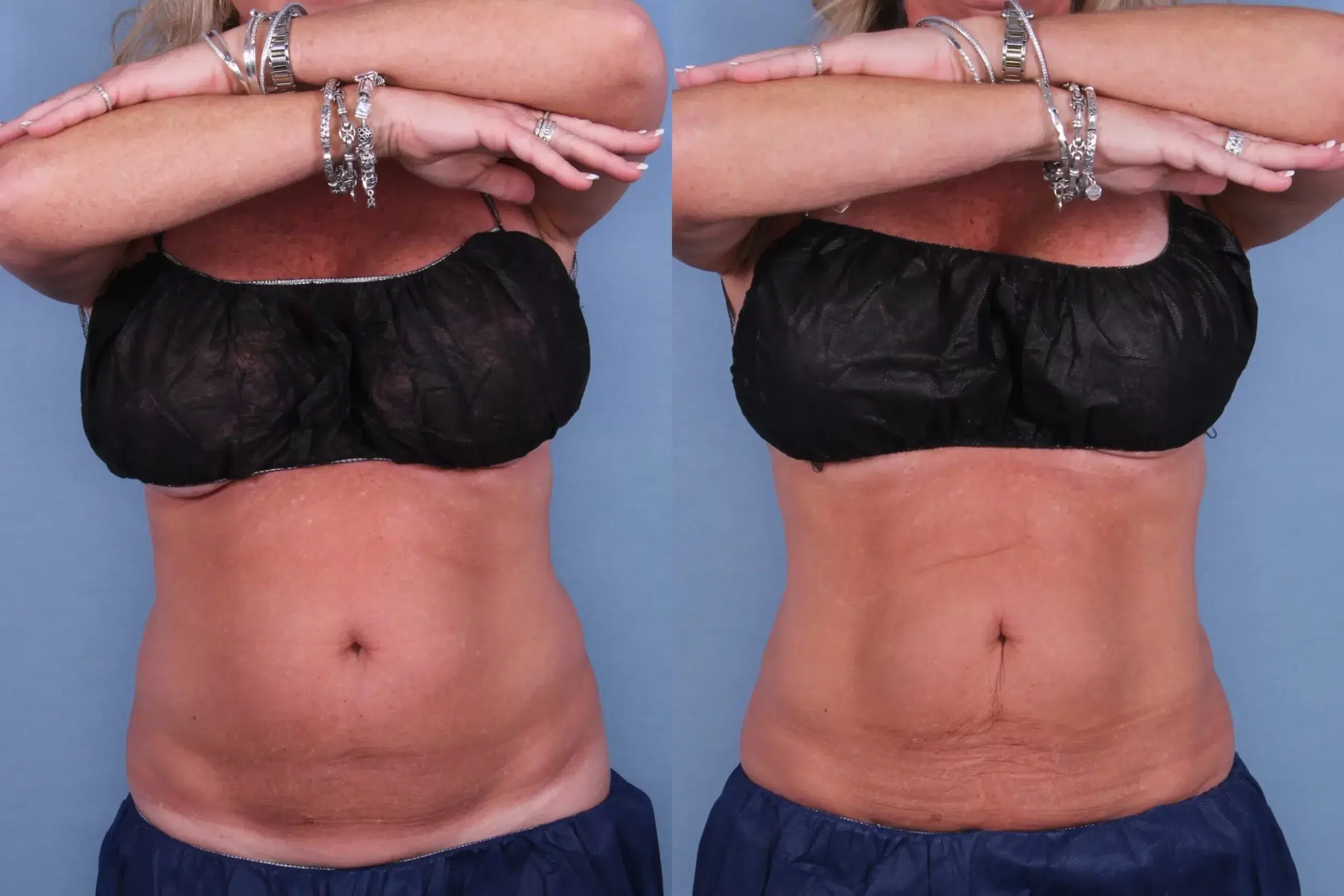 Before and After Image: CoolSculpting Case #56433 - front