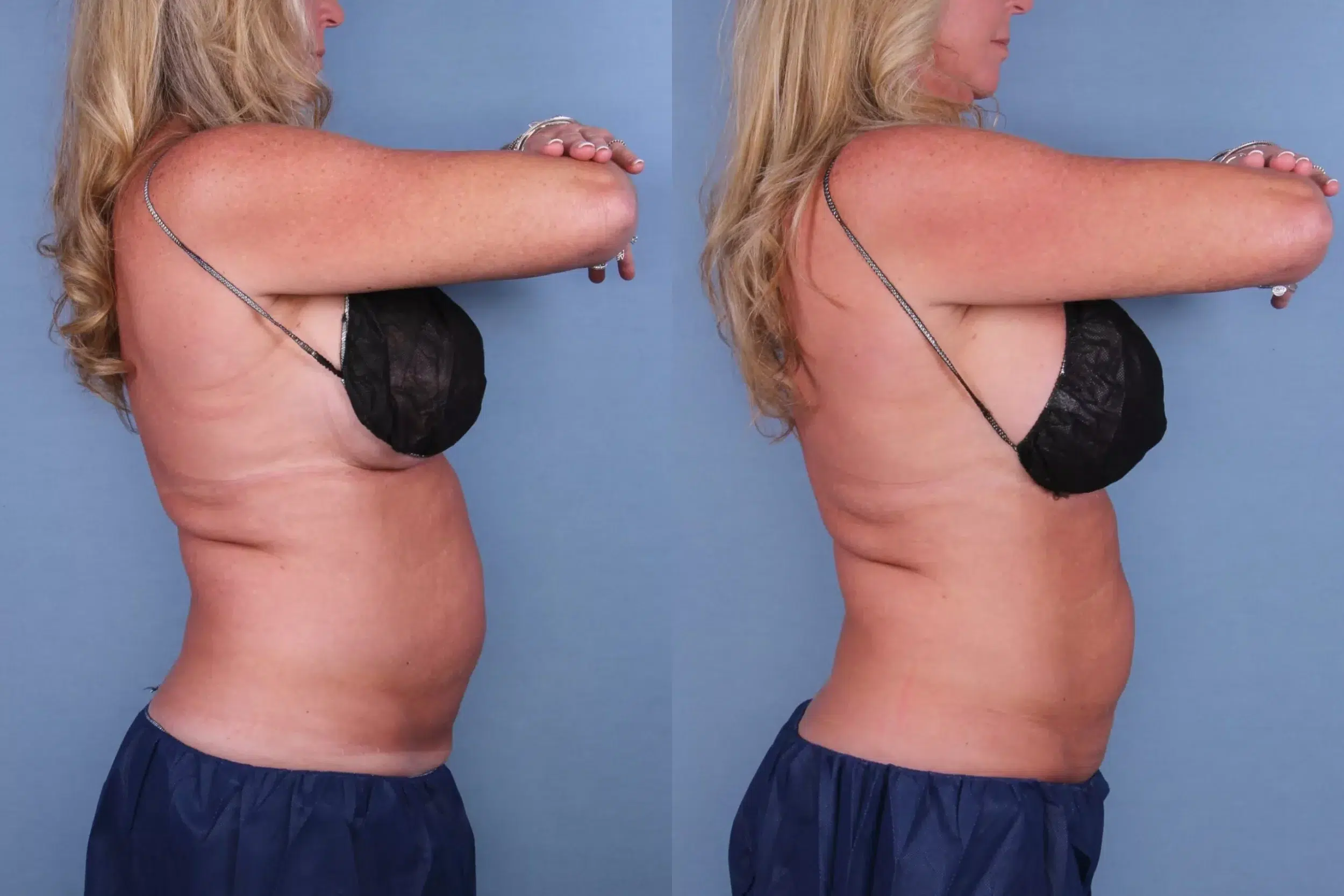 Before and After Image: CoolSculpting Case #56433 - right-side