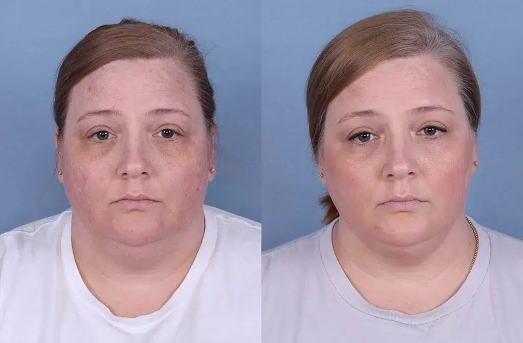 Before and After Image: CoolSculpting Case #64791 - front