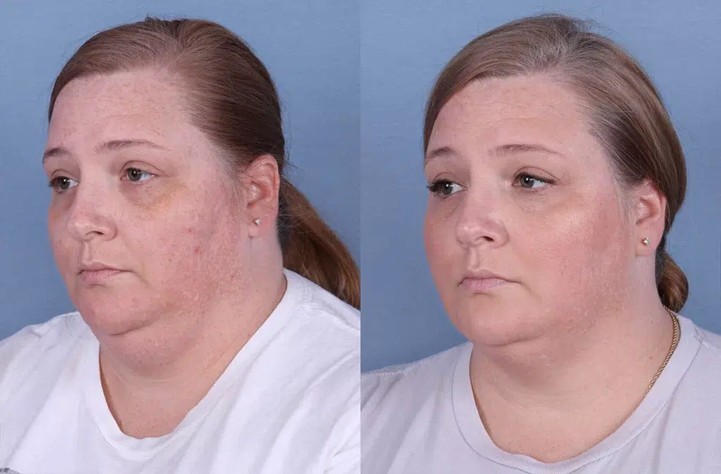 Before and After Image: CoolSculpting Case #64791 - left-front-oblique