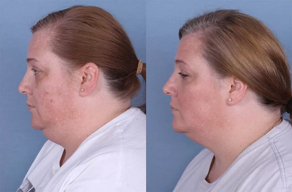 Before and After Image: CoolSculpting Case #64791 - left-side
