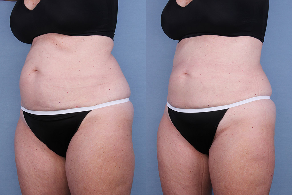 Before and After Image: CoolSculpting Case #65145 - left-front-oblique