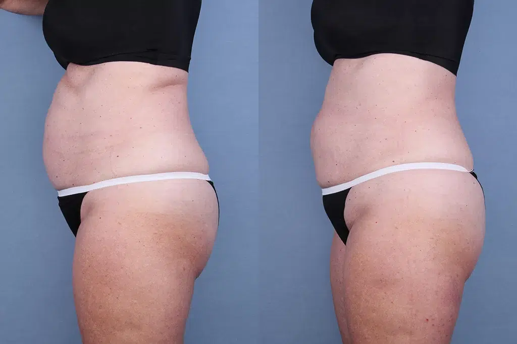 Before and After Image: CoolSculpting Case #65145 - left-side