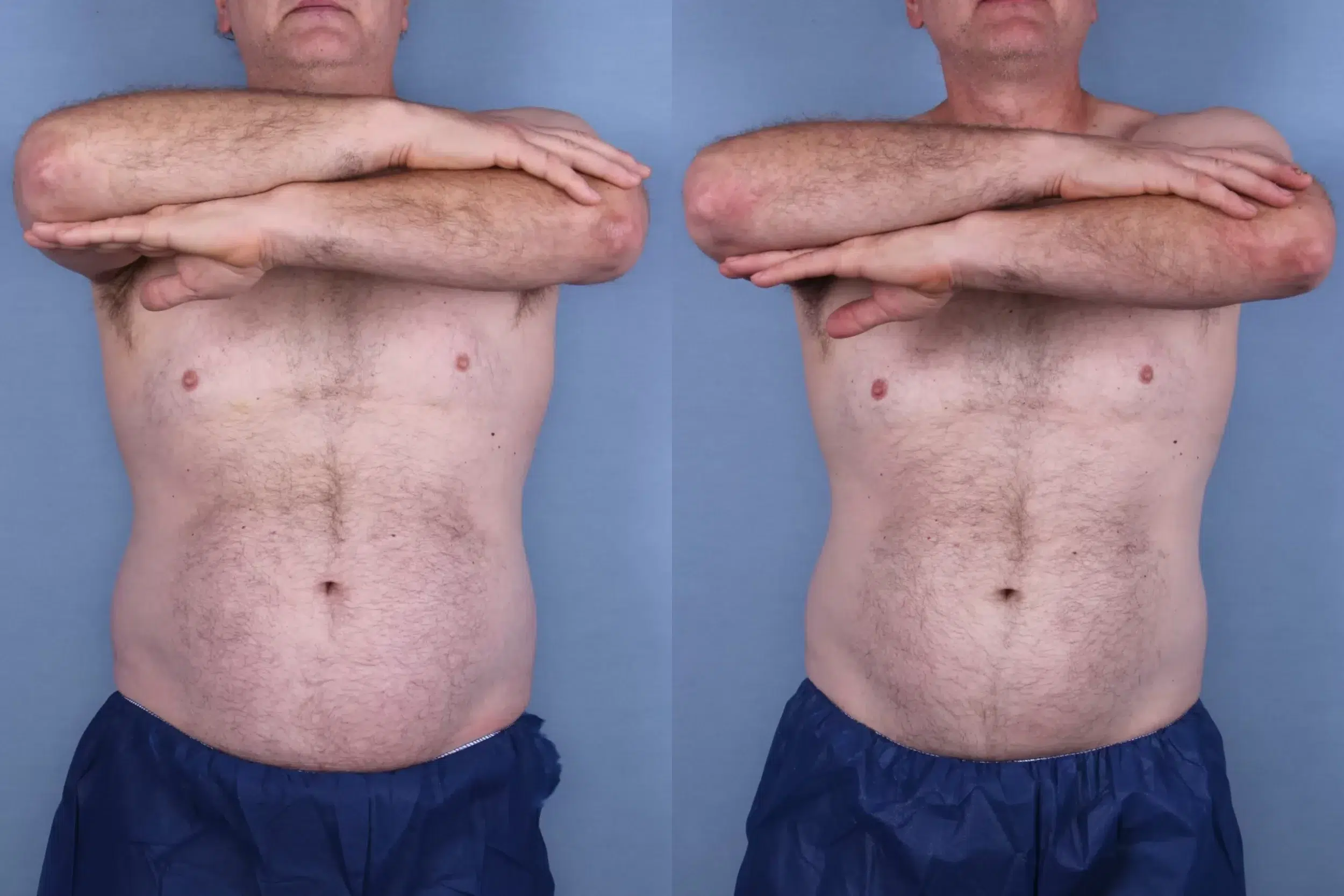 Before and After Image: CoolSculpting Case #66116 - front