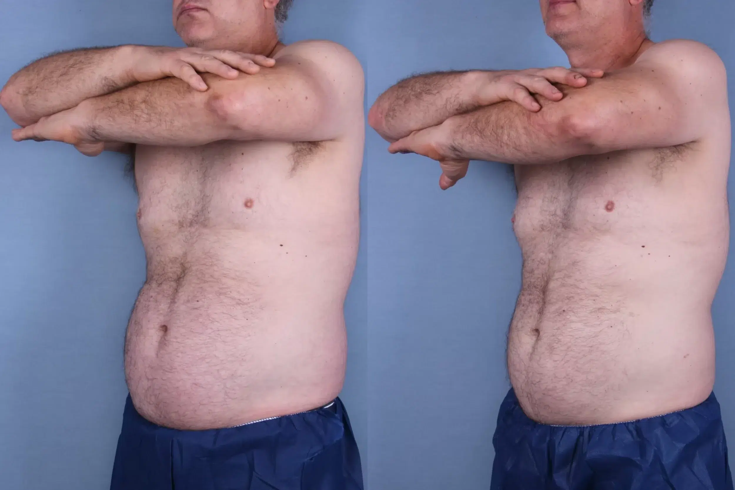 Before and After Image: CoolSculpting Case #66116 - left-front-oblique