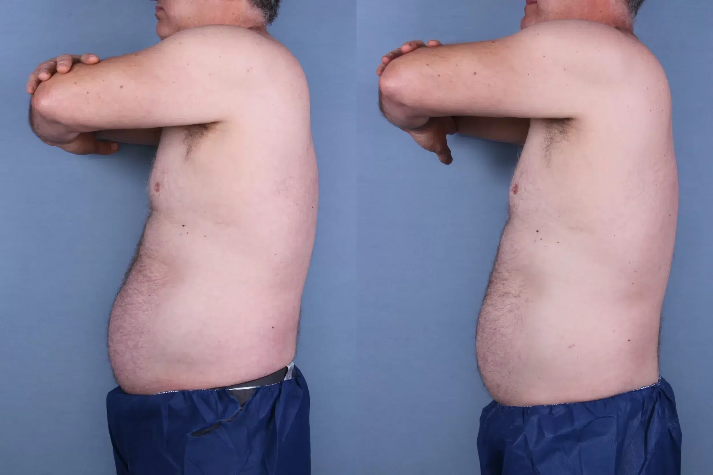 Before and After Image: CoolSculpting Case #66116 - left-side