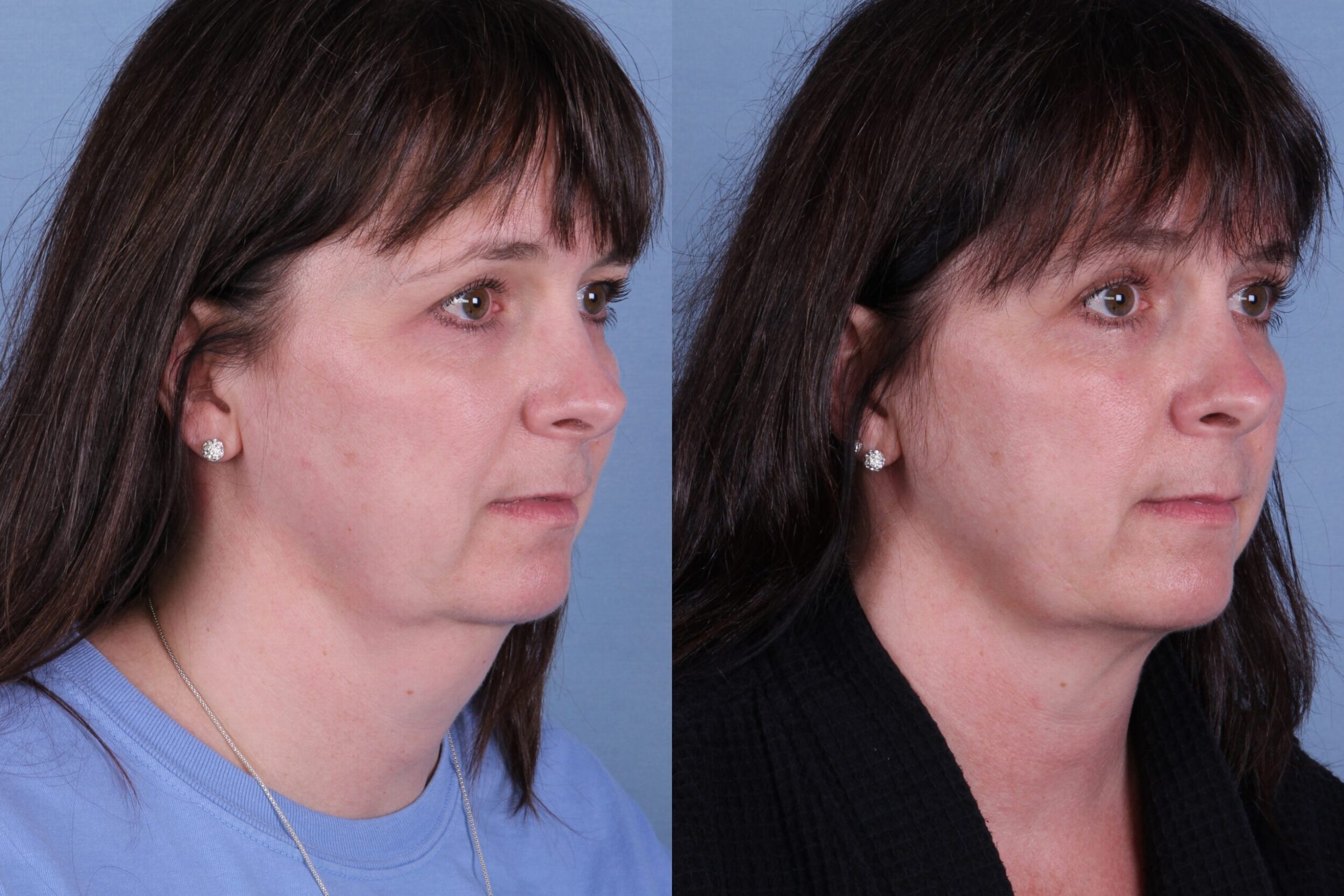 Before and After Image: CoolSculpting Case #66783 - right-front-oblique