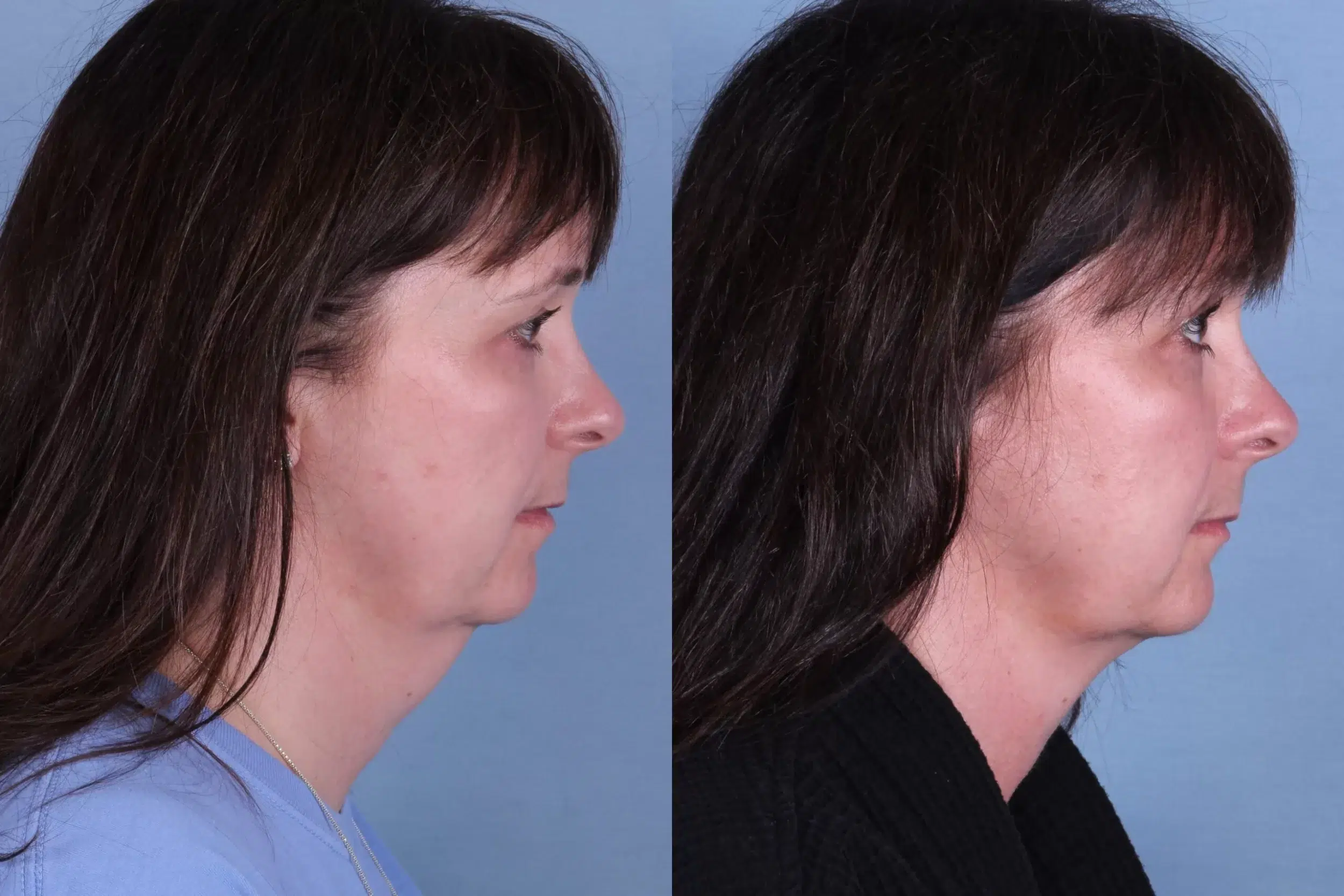 Before and After Image: CoolSculpting Case #66783 - right-side