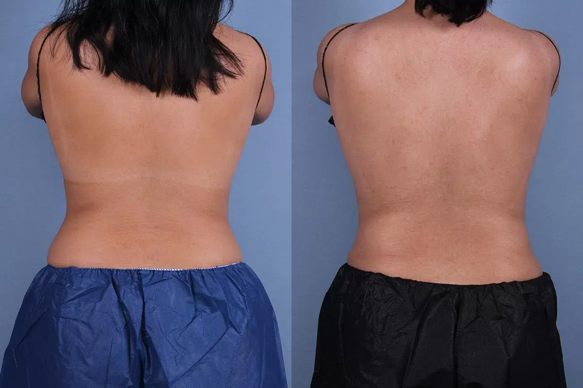 Before and After Image: CoolSculpting Case #67159 - back