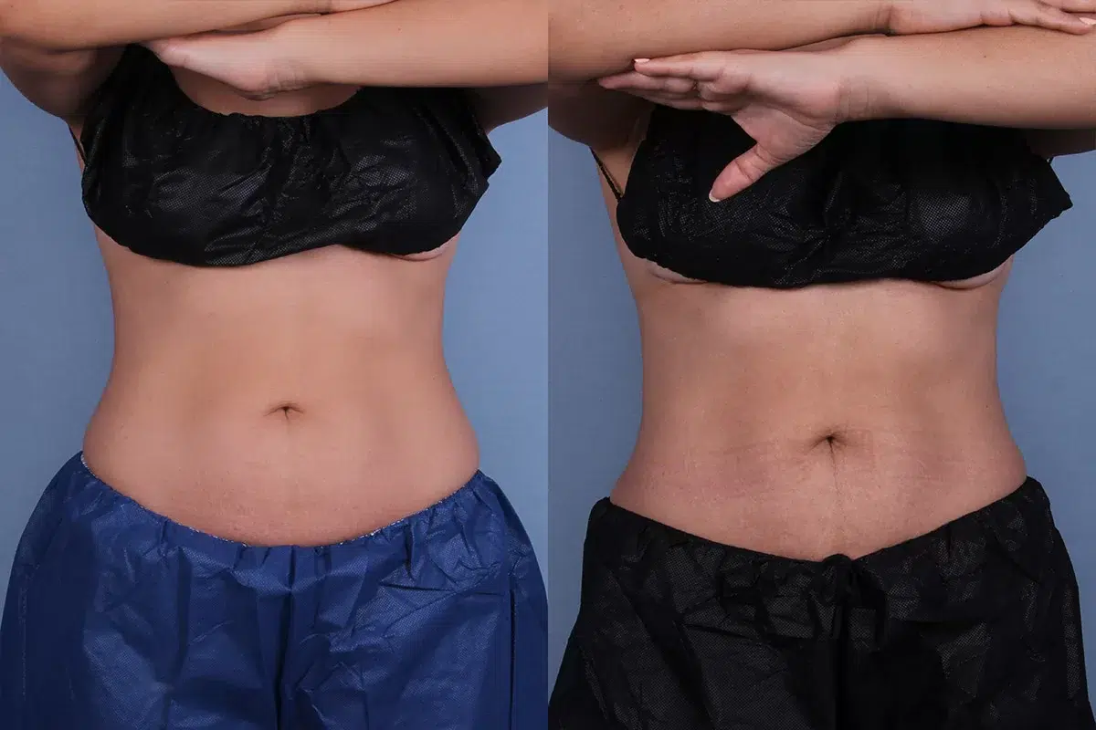Before and After Image: CoolSculpting Case #67159 - front