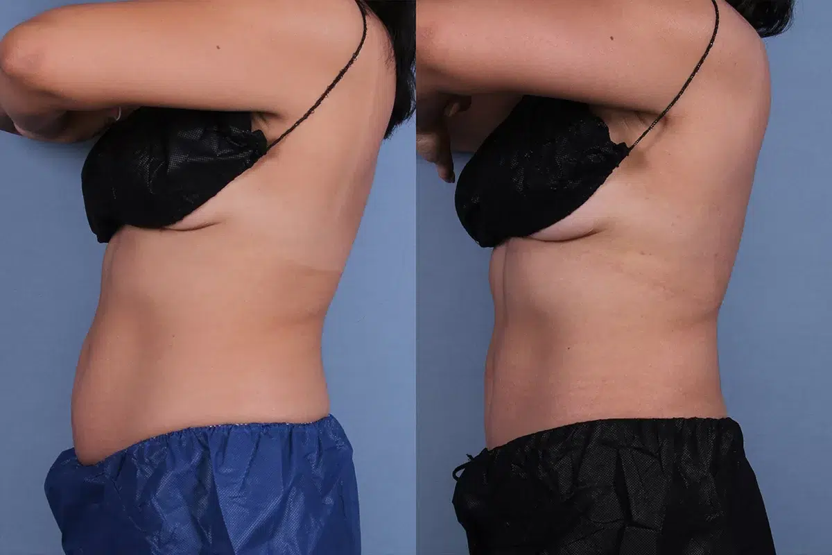 Before and After Image: CoolSculpting Case #67159 - left-side