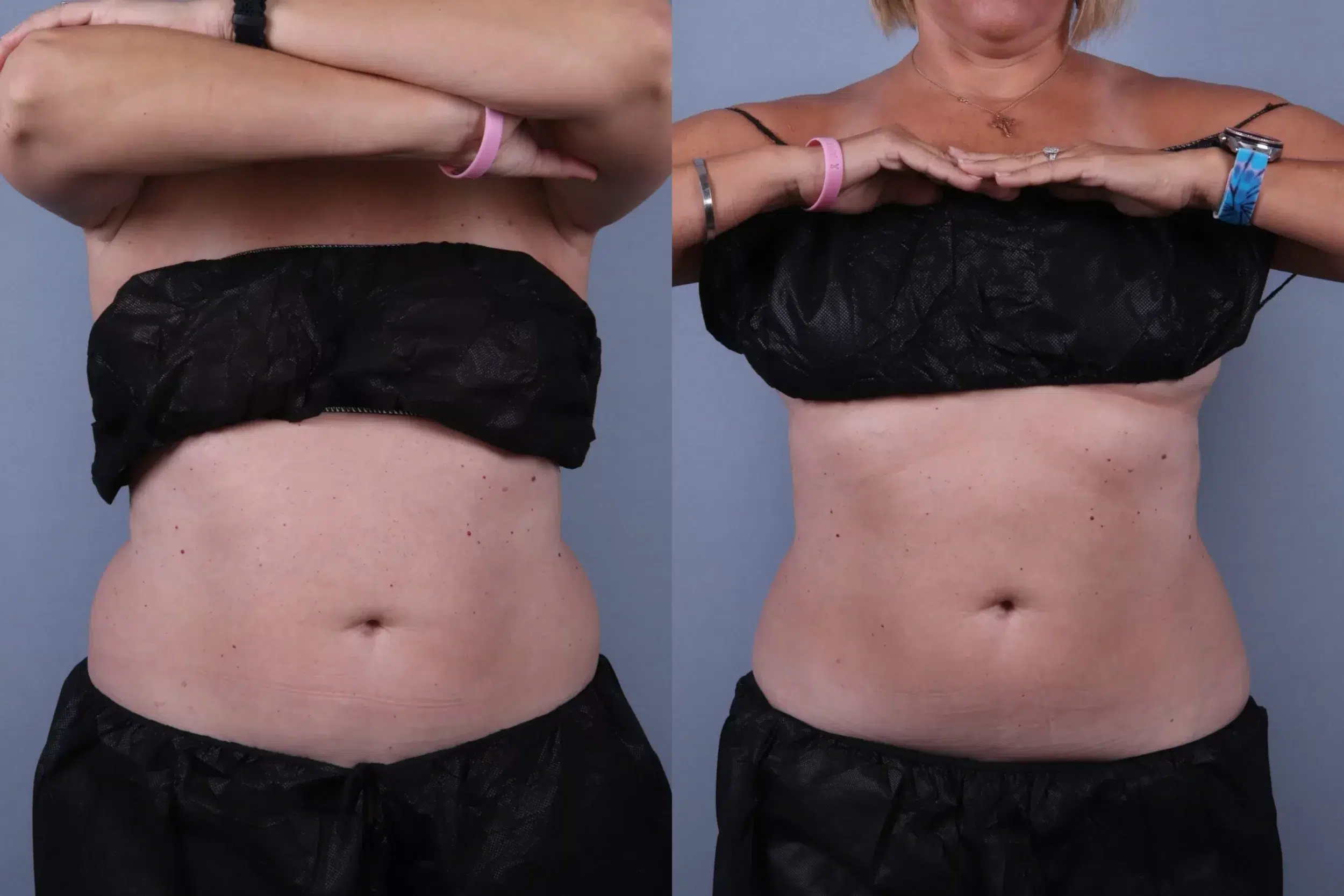 Before and After Image: CoolSculpting Case #74421 - front