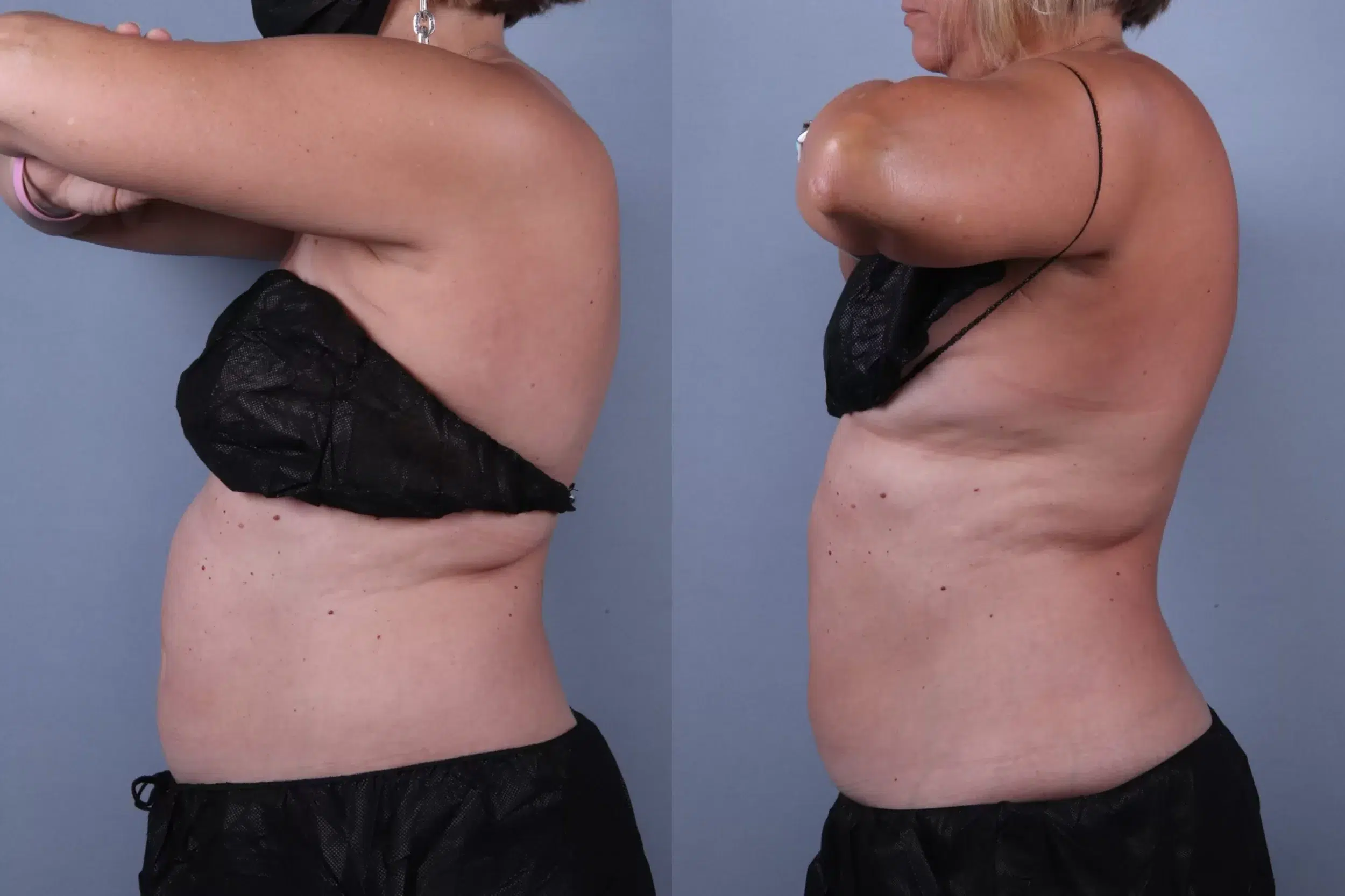 Before and After Image: CoolSculpting Case #74421 - left-side