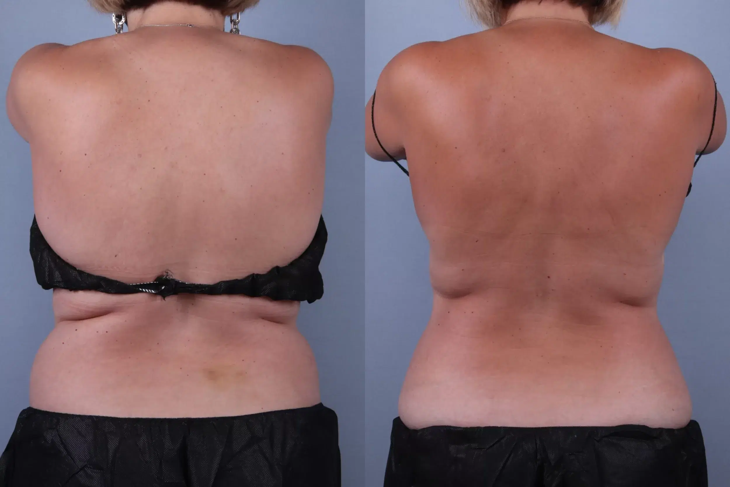 Before and After Image: CoolSculpting Case #74421 - back