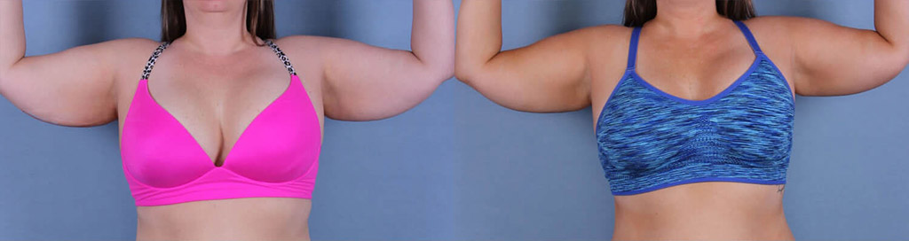 Before and After Image: CoolSculpting Case #26479 - front