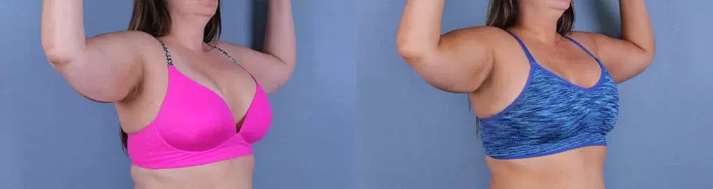 Before and After Image: CoolSculpting Case #26479 - right-front-oblique