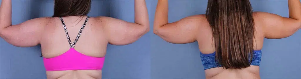 Before and After Image: CoolSculpting Case #26479 - back