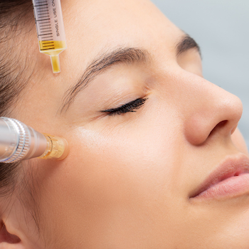 Woman having micro needling treatment reducing crow's feet